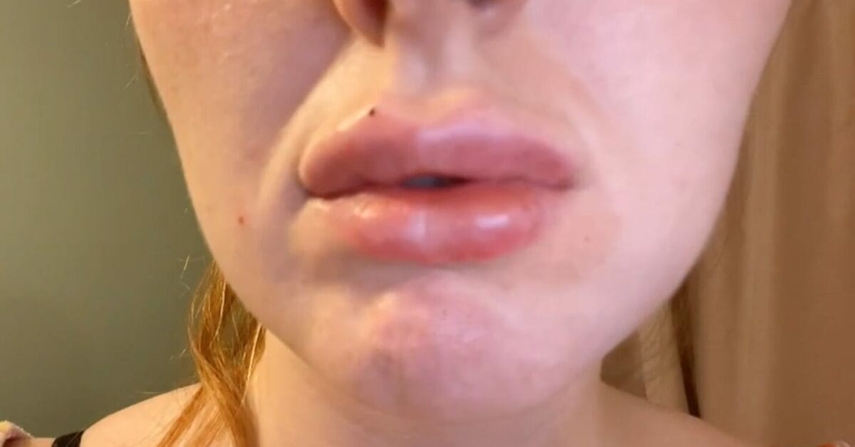 derma fillers