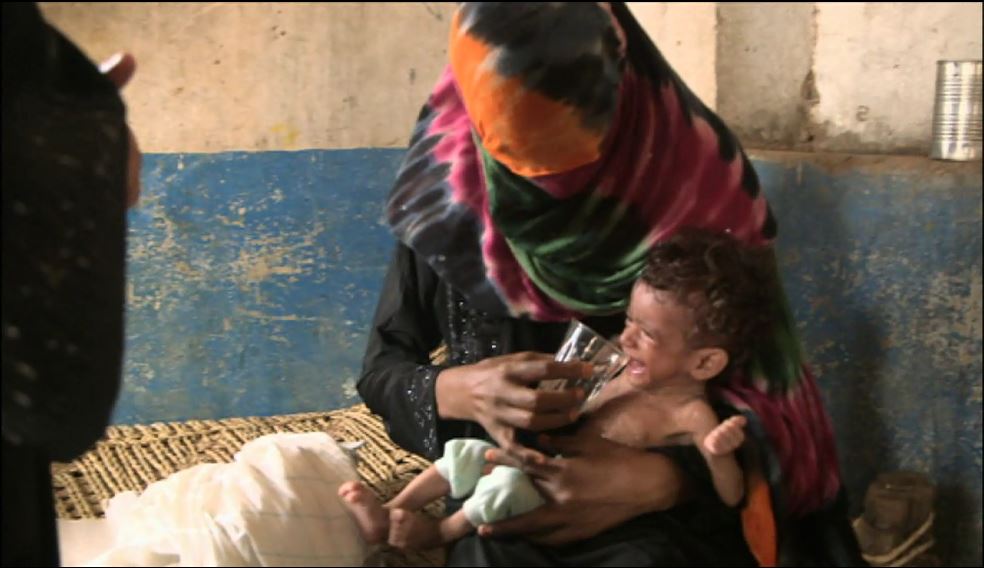 Malnourished child, Yemen Hundreds of thousands Yemeni children face starvation 6